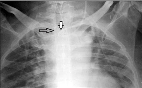 Figure From Central Venous Catheter Malposition Due To Dialysis Catheter A Case Report