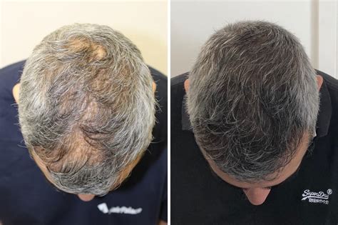 Also called survivor syndrome or survivor's syndrome and survivor disorder or survivor's disorder) is a mental condition that occurs when a person believes they have done something wrong by surviving a traumatic or tragic event when others did not. Density restoration with 5000 transplanted hairs - HairPalace
