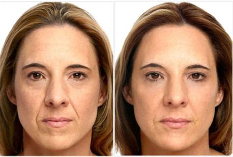 Botox Before And After Desmotsdart Image Blog