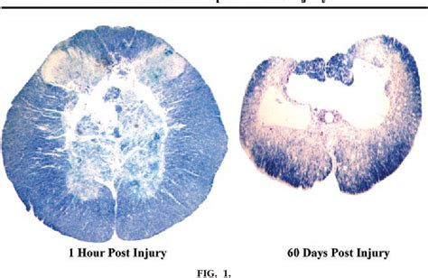 Figure From Recent Advances In Pathophysiology And Treatment Of Spinal Cord Injury Semantic