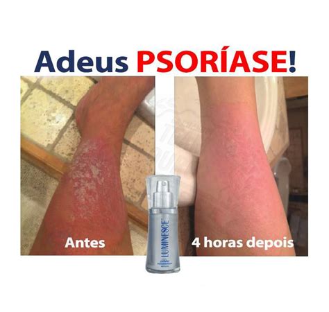Manter a boa hidratação da pele, com os cuidados com o banho também são importantes, mesmo nos casos leves da psoríase. Testemunha tinha psoríase na perna esquerda. Psoríase ...