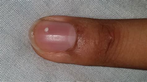 What Causes Black Spots On Fingernails Design Talk