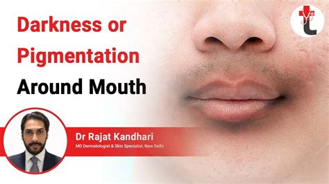 Darkness Or Pigmentation Around Mouth Darkening Around Mouth Causes