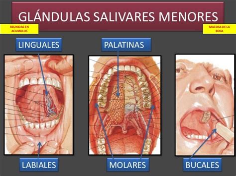 Sialoadenitis Una Inflamación De Las Glándulas Salivales
