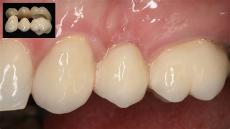 Qué es un puente dental Puente sobre implantes dentales