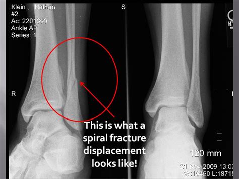 Tibia and fibula are not uncommon, and many surgeons. Fracture Of Fibula - Fracture Treatment