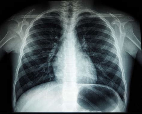 What Do Chest X Rays Show