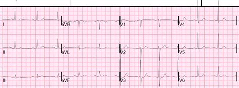 Unstable angina, or acute coronary syndrome, is a type of chest pain or discomfort that typically occurs when a person is resting. Dr. Smith's ECG Blog: Unstable Angina: Again, it still ...