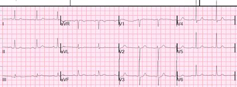 A repeat ecg at the time was significant. Dr. Smith's ECG Blog: Unstable Angina: Again, it still ...