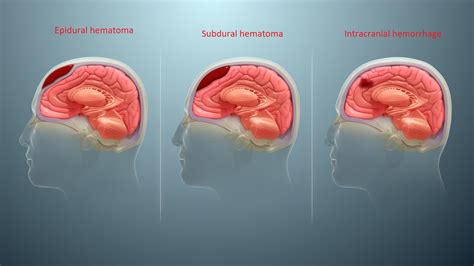 Subdural Hematoma Vs Subarachnoid Hemorrhage