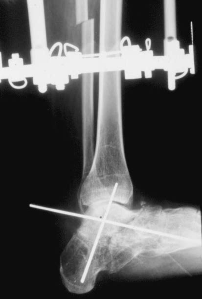 Intraoperative Plain X Ray Lateral View Showing Y Osteotomy Artrorisi