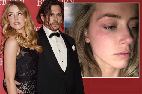 Amber Heard Pictured With Bruised Face As She Bids For Restraining