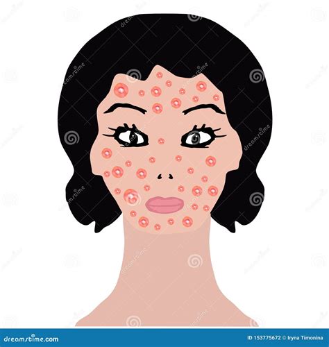 Rash On Face Allergy Dermatitis Acne Pimples Infographics Vector
