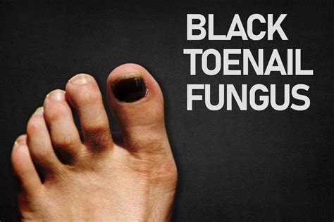 Black Toenail Fungus Black Nail Treatments Causes What Is It