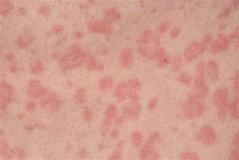 Coronavirus Symptoms Rash Micropedia