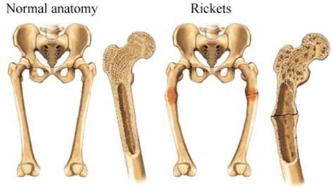 The data on enriched food products used in children's nutrition and content of vitamin d in them were presented. Vitamin D Deficiency Causes Osteomalacia and Rickets ...