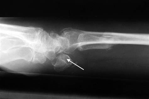 Dislocation Wrist Lunate Hand Surgery Source