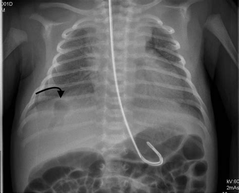 Plain X Ray Showing Placements Of Tubes Naso Gastric Tube In The My