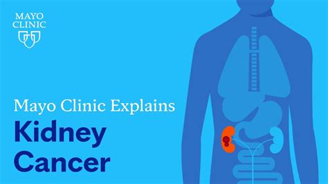 Mayo Clinic Explains Kidney Cancer Youtube