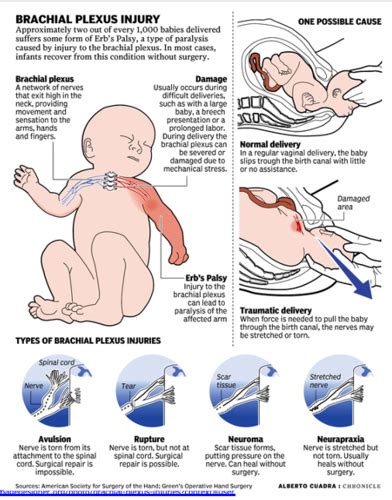 Peds Pp 18 Perinatal Brachial Plexus Injuries Flashcards Quizlet