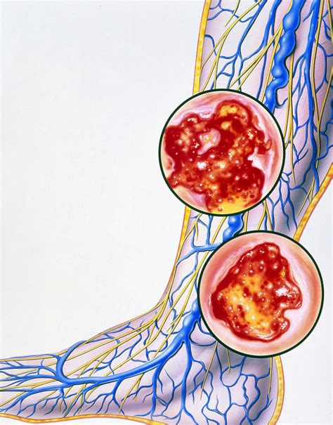 Artwork Of Varicose Veins And Leg Ulcers Photograph By John Bavosi Pixels