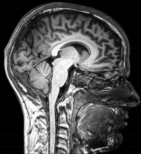Mri Scan Normal Brain Sagital View Neuroscience News