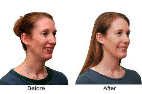 Corrective Jaw Surgery Orthognathic Reynolds Oral And Facial Surgery