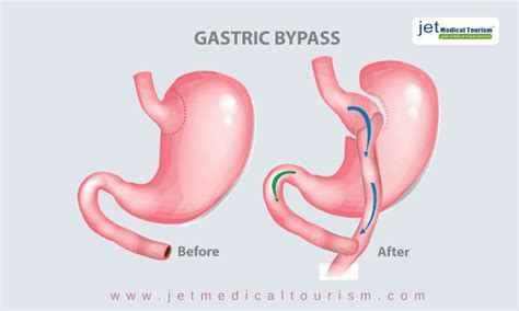 Gastric Bypass Complications Jet Medical Tourism®