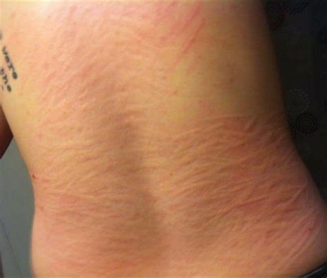 Pin On Dermatographia Urticaria Causes