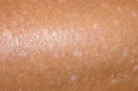 White Spots On Skin Causes Sun Legs Pictures Fungus V