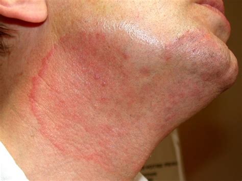 Dermatophytes That Causes Cutaneous Mycoses In Humans And How To Deal