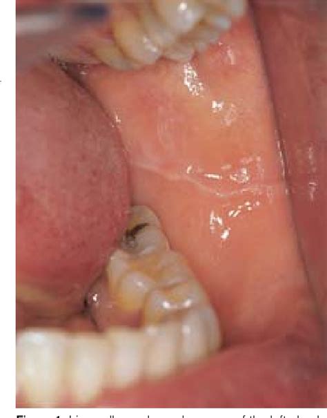 Figure 1 From Oral Mucosa Variations From Normalcy Part I Semantic