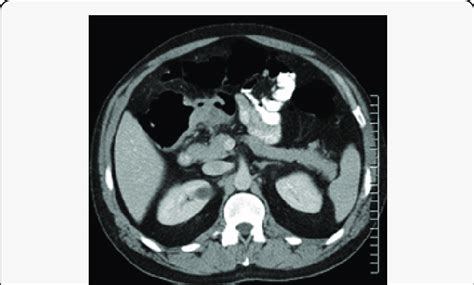 Axial Ct Scan Of The Chest Abdomen And Pelvis With Iv And Oral