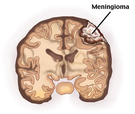 Meningioma Meningiomas Multiple Meningiomatosis Benign Meningioma