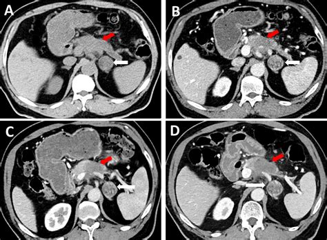 Frontiers An Unexpected Case Report Of Adrenal Lymphangioma