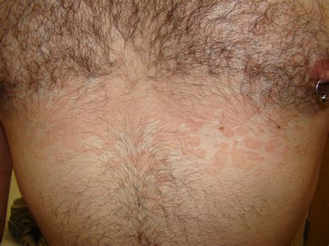Young Man With A Rash On His Chest