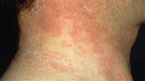 Is That Rash Psoriasis Psoriasis Pictures And More