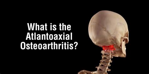 Atlantoaxial Osteoarthritis Stavya Spine