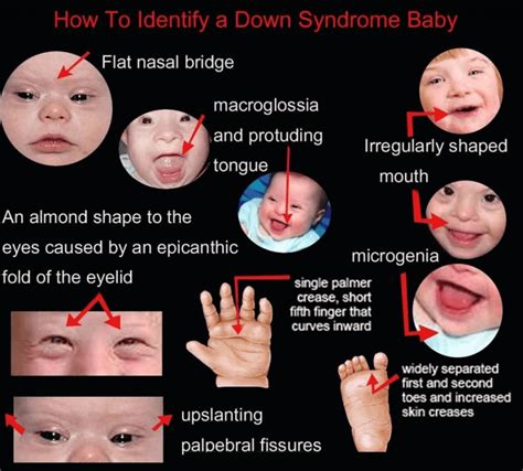 9 Down Syndrome Facts That You Never Knew - Just Credible gambar png