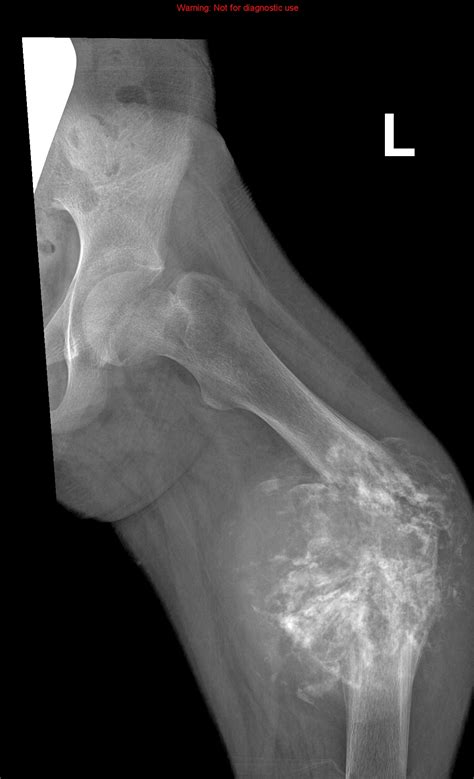 Telangiectatic Osteosarcoma Image