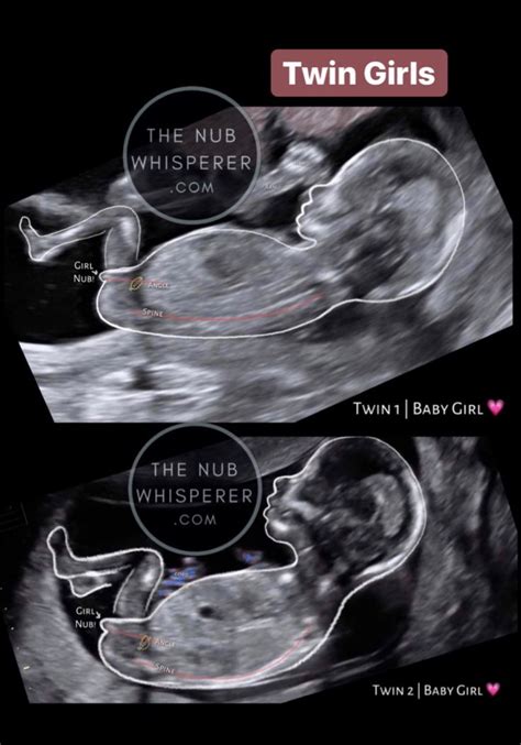 12 week ultrasound pictures gender