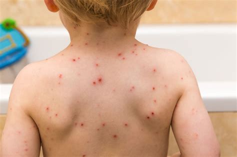 Lets Not Forget That Chicken Pox Can Be A Serious Disease