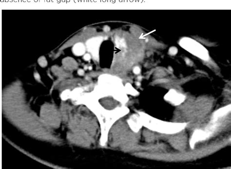 Figure 3 From Ct And Mr Imaging Of Thyroid Carcinoma Showing Thymus