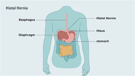 An Ultimate Guide To Hiatal Hernia Dr Samrat Jankar