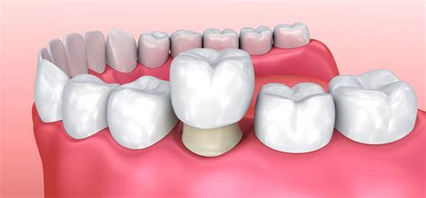 Audy dental adalah klinik gigi spesialis terbesar terpercaya di indonesia. Daftar Harga Crown Gigi Beserta Jenis Terbaiknya - FDC ...