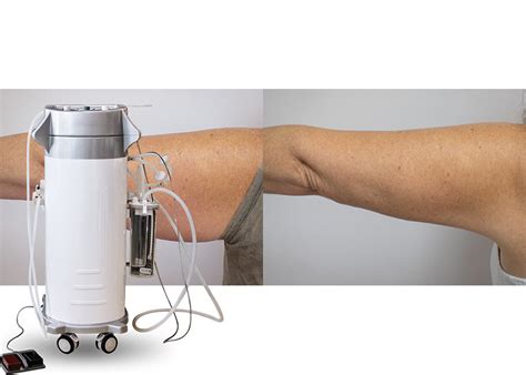 Power Assisted Surgical Vacuum Liposuction Cavitation Machine For