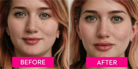 A Guide To Lip Injections From The Cost To How They Feel Before And