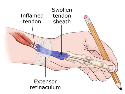 De Quervain S Tenosynovitis Symptoms And Treatment Orthoinfo Aaos