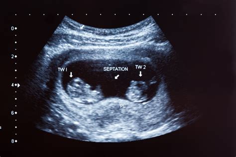 Monozygotic Twins Ultrasound