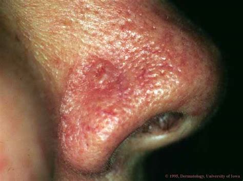 Skin Cancer Picture From Ui Dermatology Hardin Md